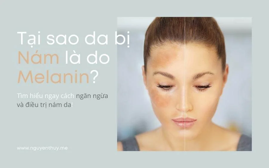 melanin nguyên nhân gây nám sạm da